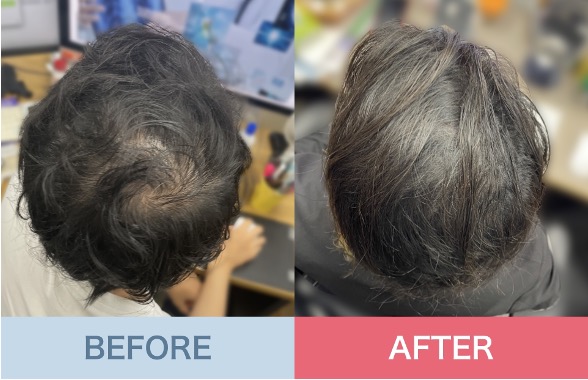 Before and after baldness treatment｜Baldness drug effects