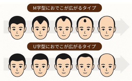 おでこ　広がり方　タイプ